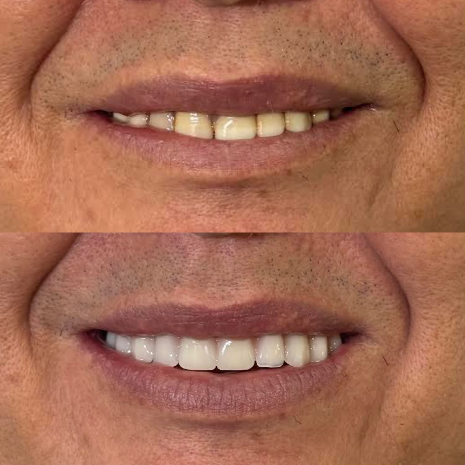 Paciente antes e depois da prótese protocolo