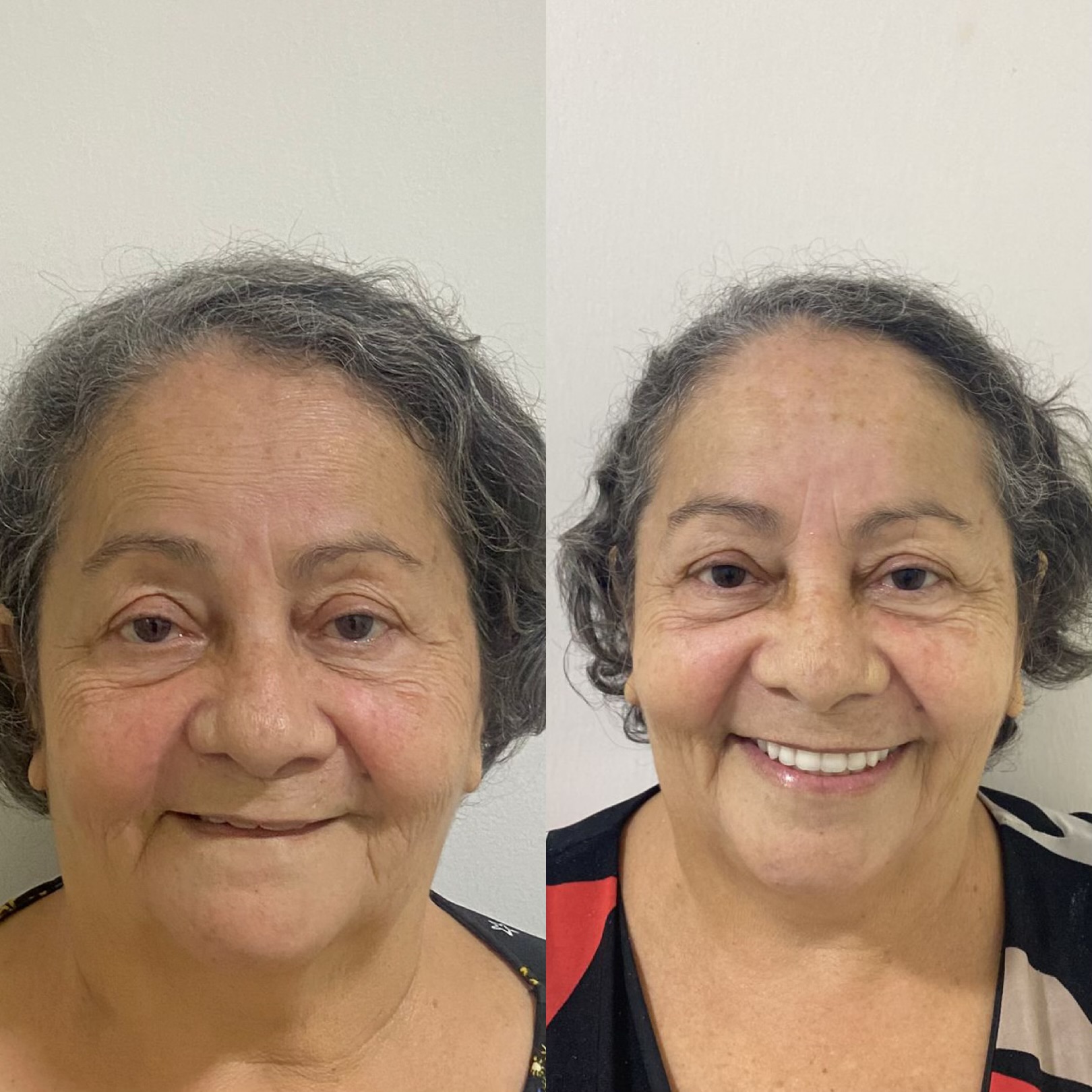 Paciente antes e depois da prótese protocolo