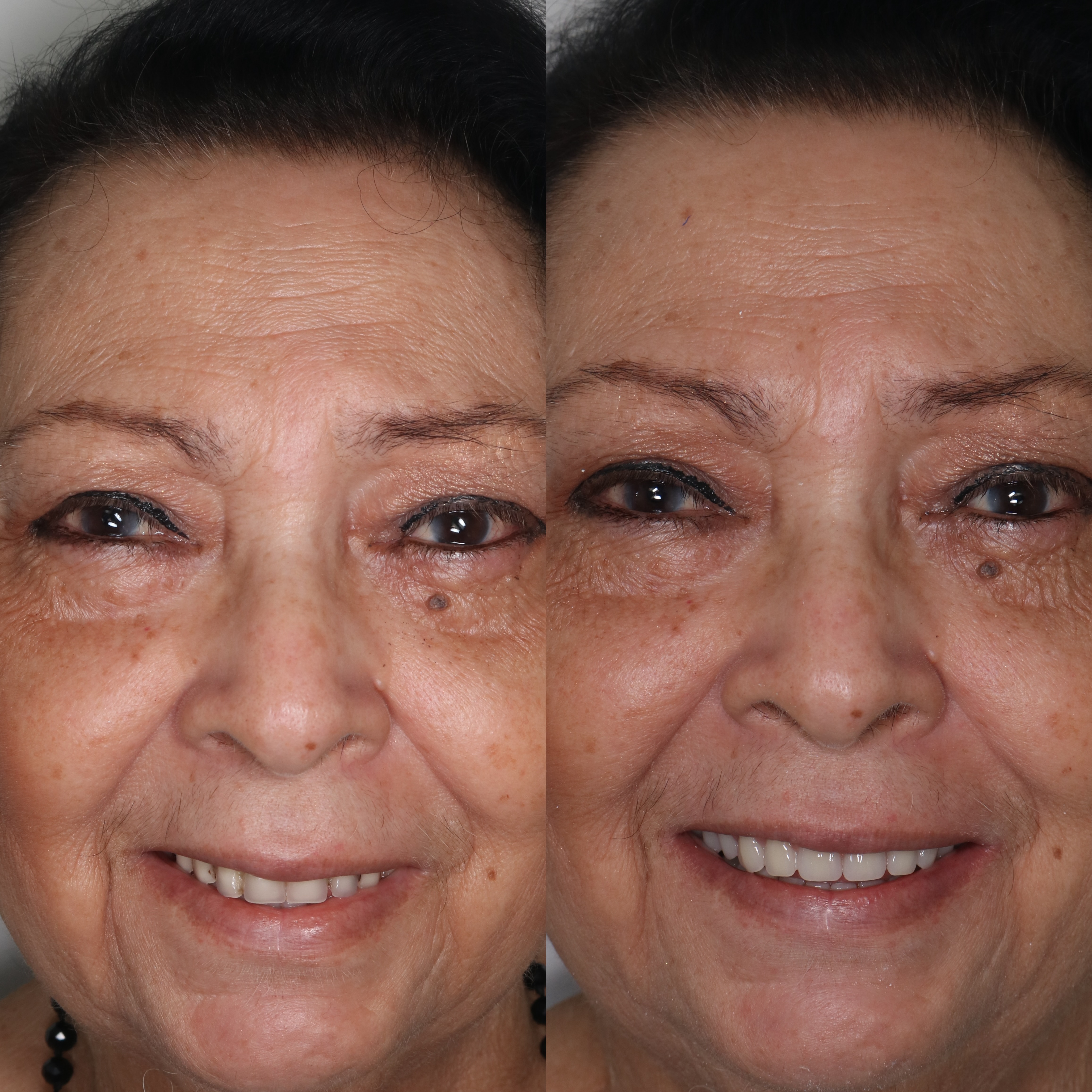 Paciente antes e depois da prótese protocolo